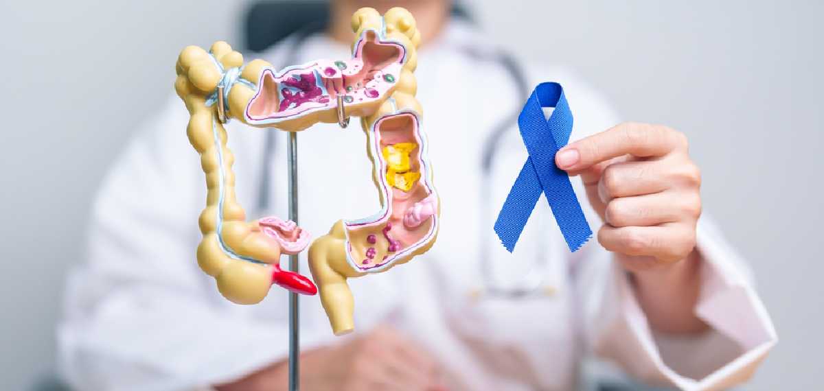 colorectal cancer