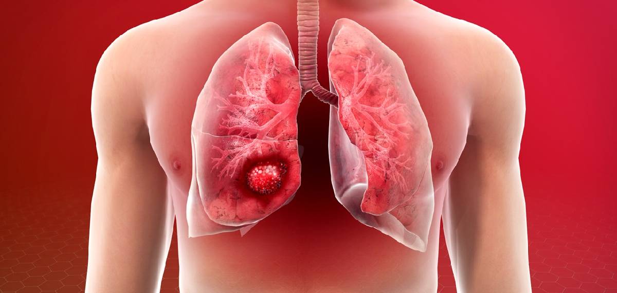 lung cancer