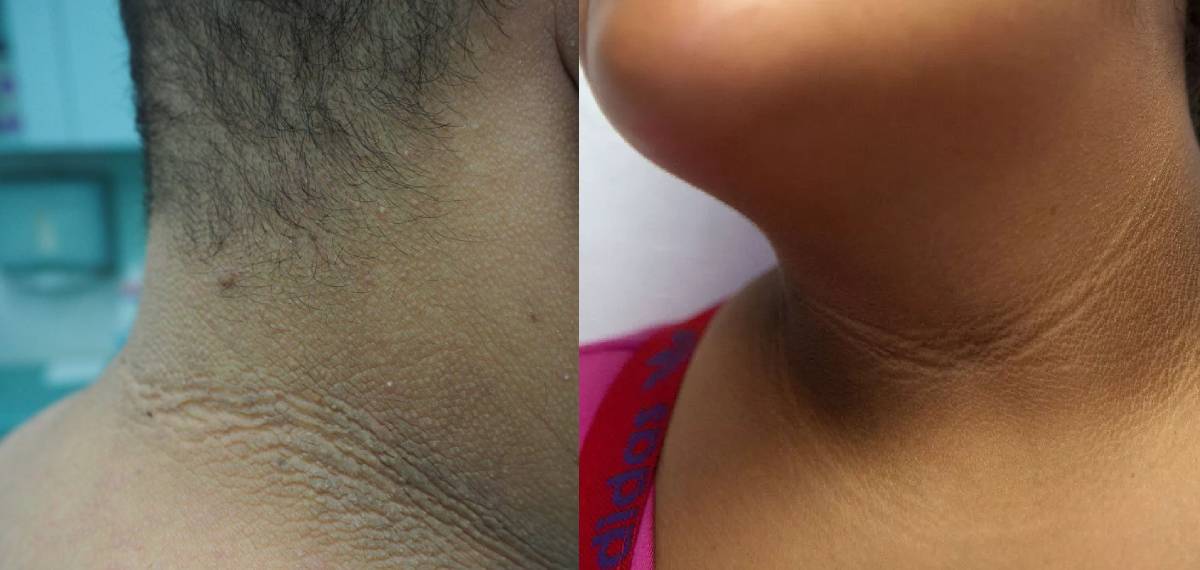 acanthosis nigricans.