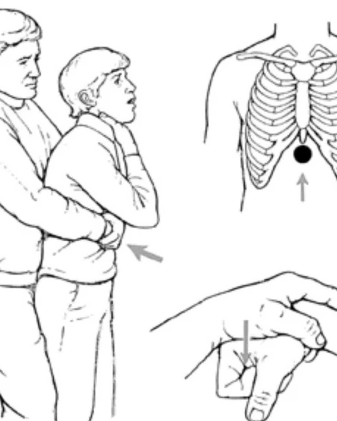 Heimlich Manoeuvre