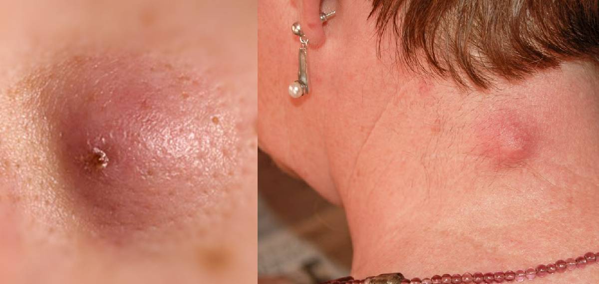 നെഞ്ച്, പുറം, കഴുത്ത്, തല; ഈ ഭാഗങ്ങളില്‍ മുഴയുണ്ടോ, ചര്‍മ്മത്തില്‍ ചുവപ്പോ നീലയോ നിറത്തില്‍ പാടുകളുണ്ടോ?