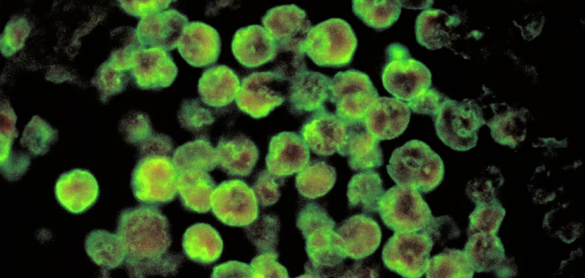 എലിപ്പനിയെ തുടർന്ന് ചികിത്സയിലിരിക്കെ അമീബിക് മസ്തിഷ്ക ജ്വരം ബാധിച്ച് 58കാരൻ മരിച്ചു