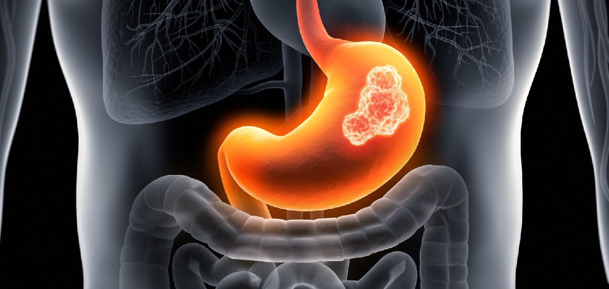 Men are more prone to Stomach Cancer