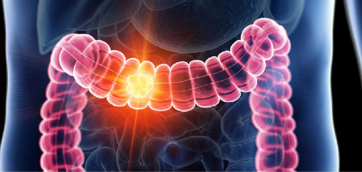 colorectal cancer
