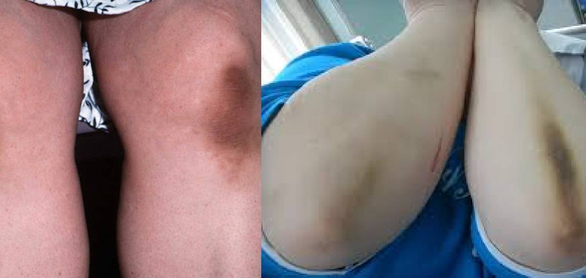 acanthosis nigricans.