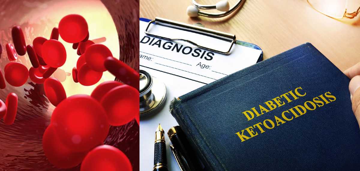 diabetic ketoacidosis