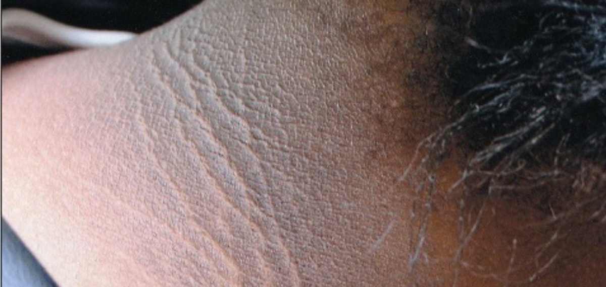 കഴുത്തിലെ കറുത്ത നിറത്തെ സൂക്ഷിക്കണം! ഗുരുതരമായ ആരോഗ്യപ്രശ്‌നമാകാം