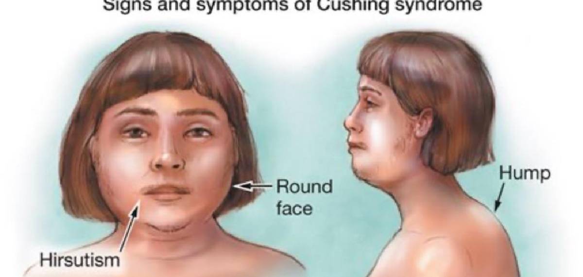 cushing syndrome