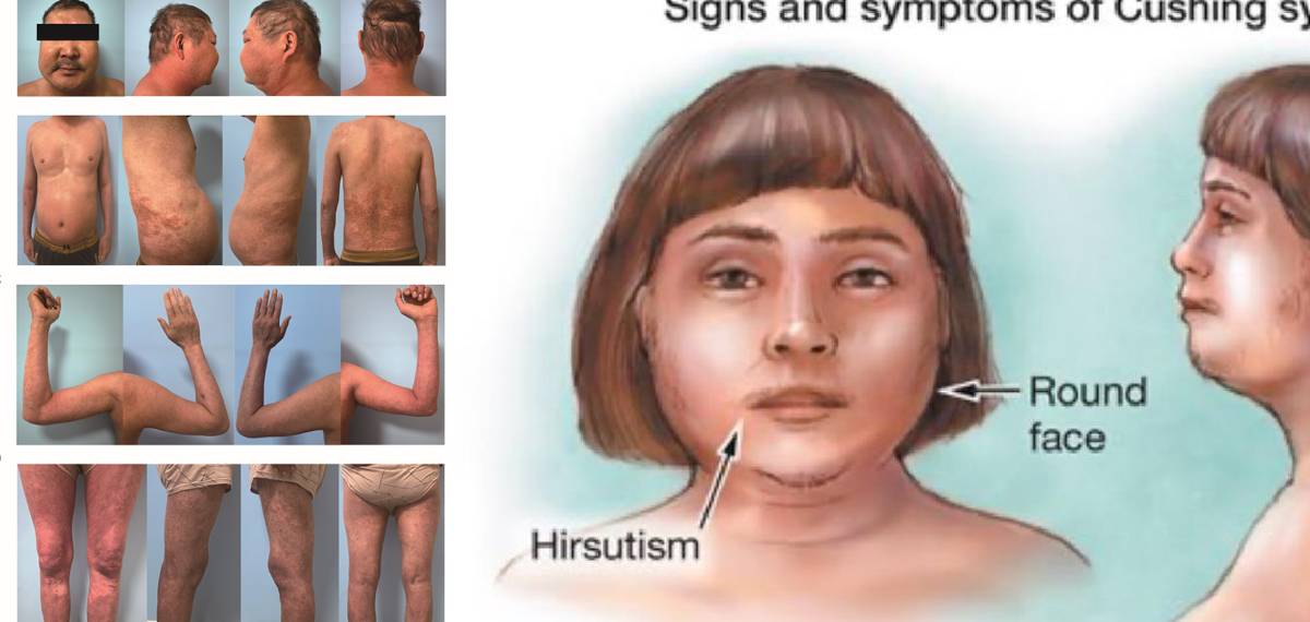 cushing syndrome