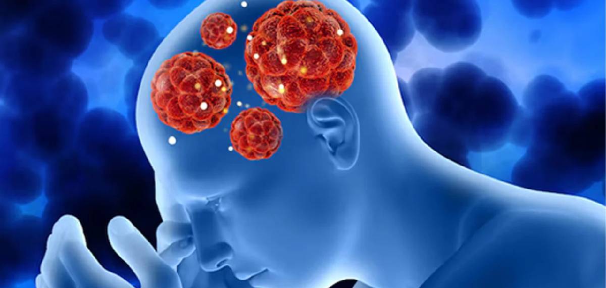 brain cancer symptoms