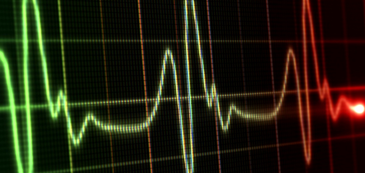 A heart attack (myocardial infarction) is a medical emergency where blood flow to the heart is blocked, causing damage or death to heart muscle tissue due to a lack of oxygen.