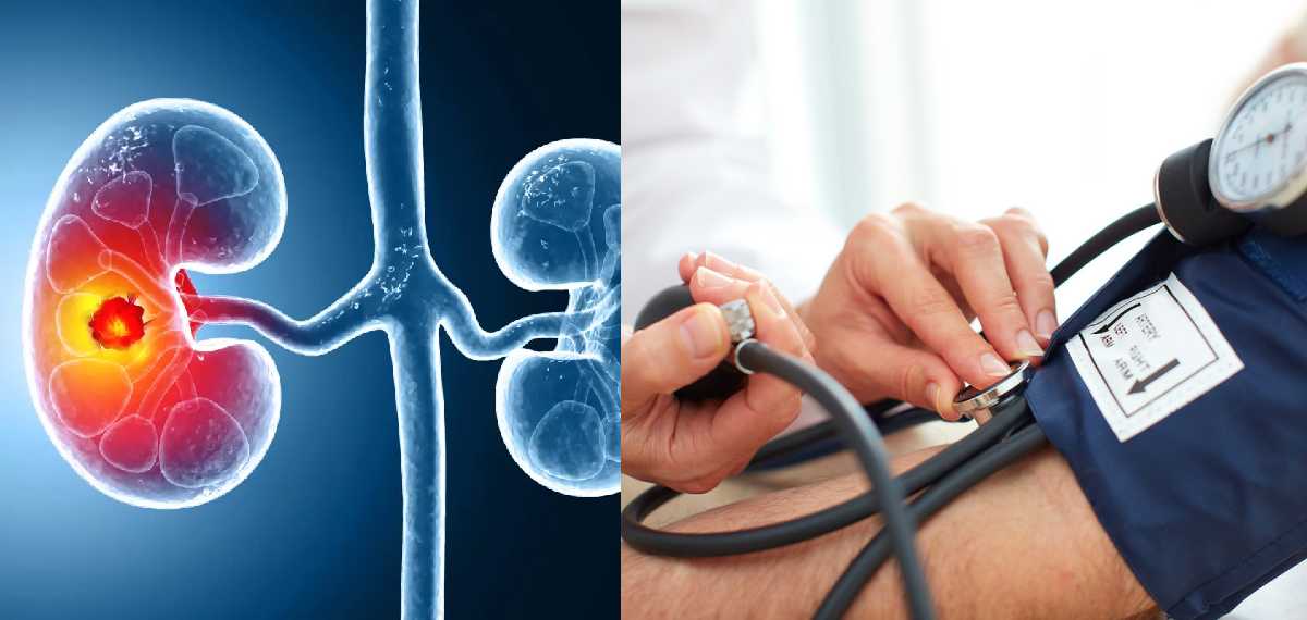 ഉയര്‍ന്ന രക്തസമ്മര്‍ദ്ദം ഉളളവര്‍ക്ക് വൃക്ക കാന്‍സറിന് സാധ്യത കൂടുതലെന്ന് പഠനം