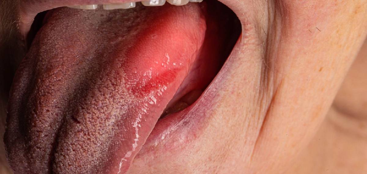 burning mouth syndrome