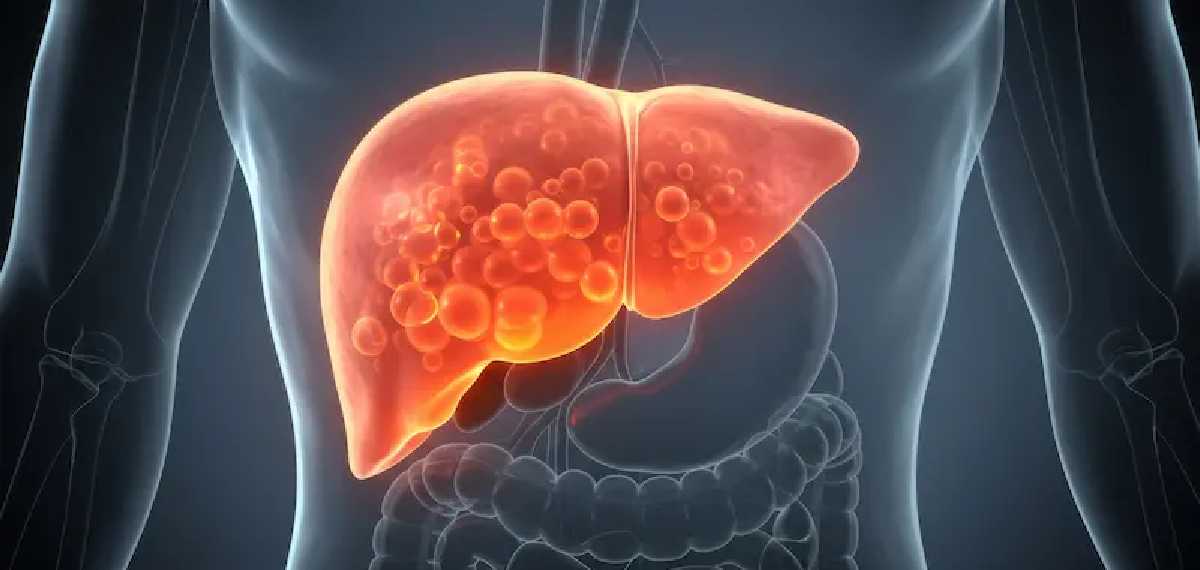 fatty liver