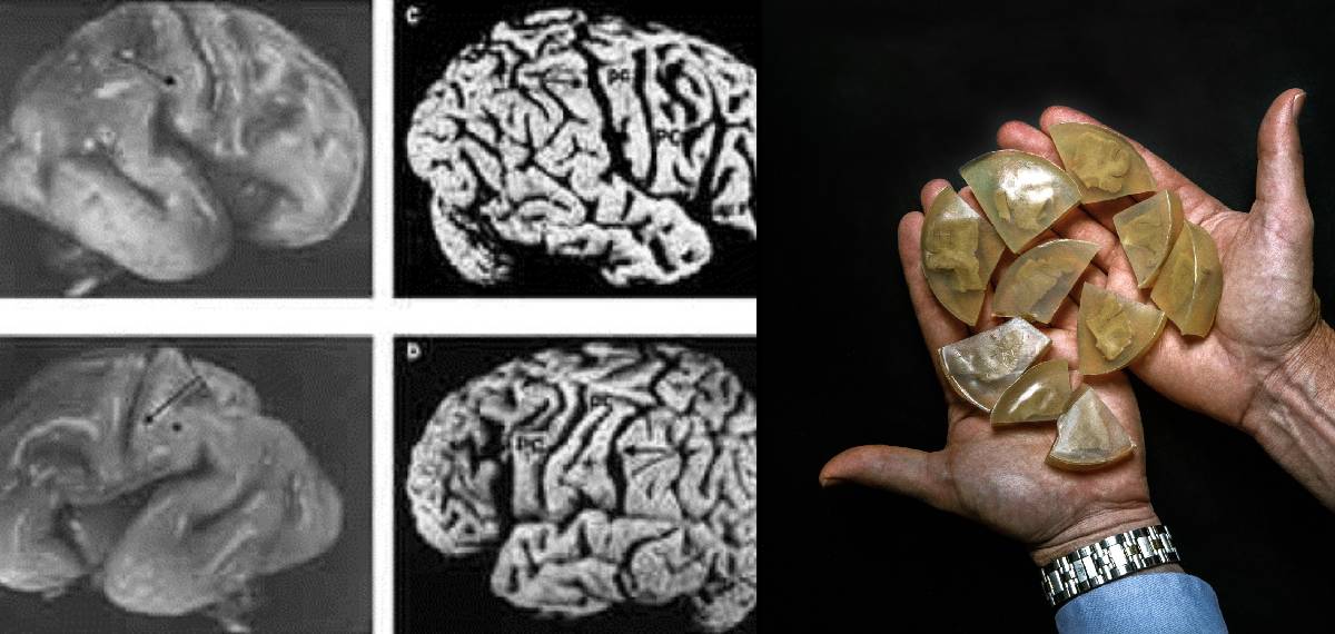 albert einstein brain