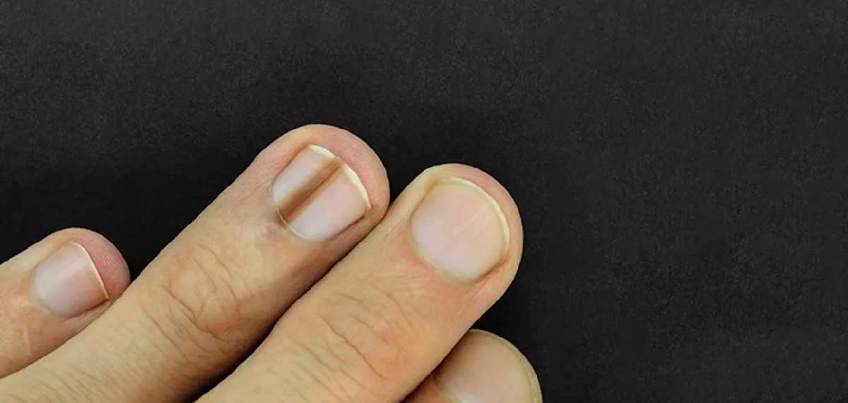 black lines in nails