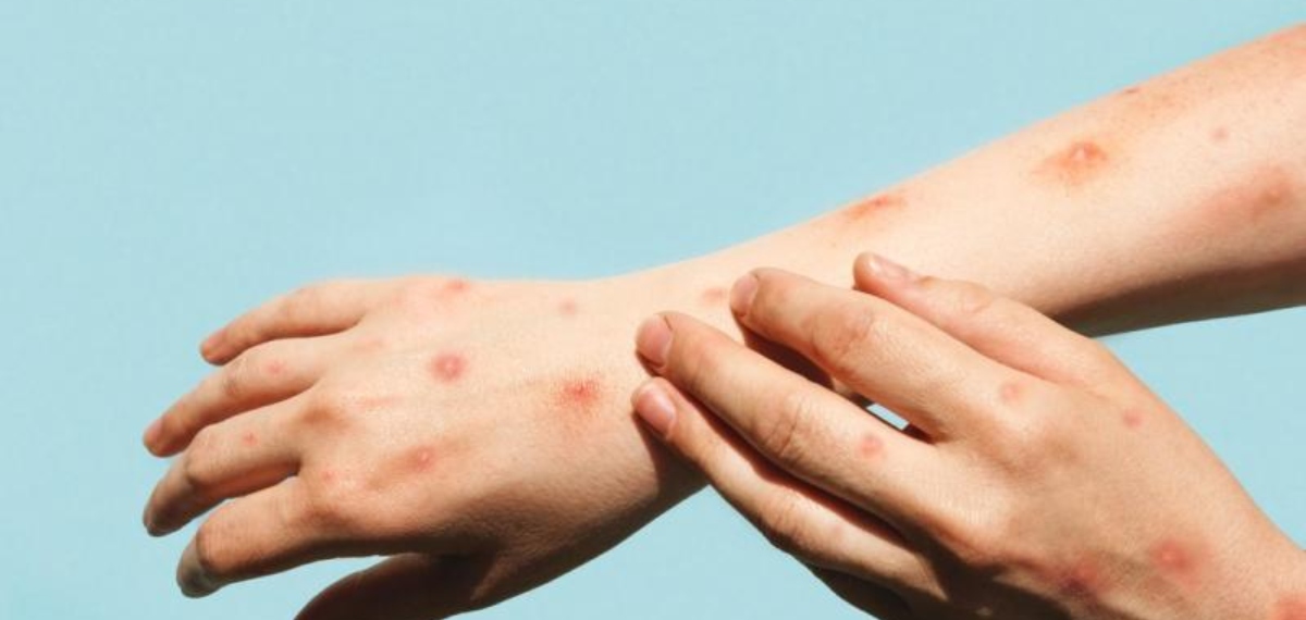 യുഎഇയിലെ എംപോക്സ് വ്യാപനം; ജാ​ഗ്രത പാലിക്കണമെന്ന് മുന്നറിയിപ്പുമായി ആരോ​ഗ്യ വിദ​​ഗ്ധർ