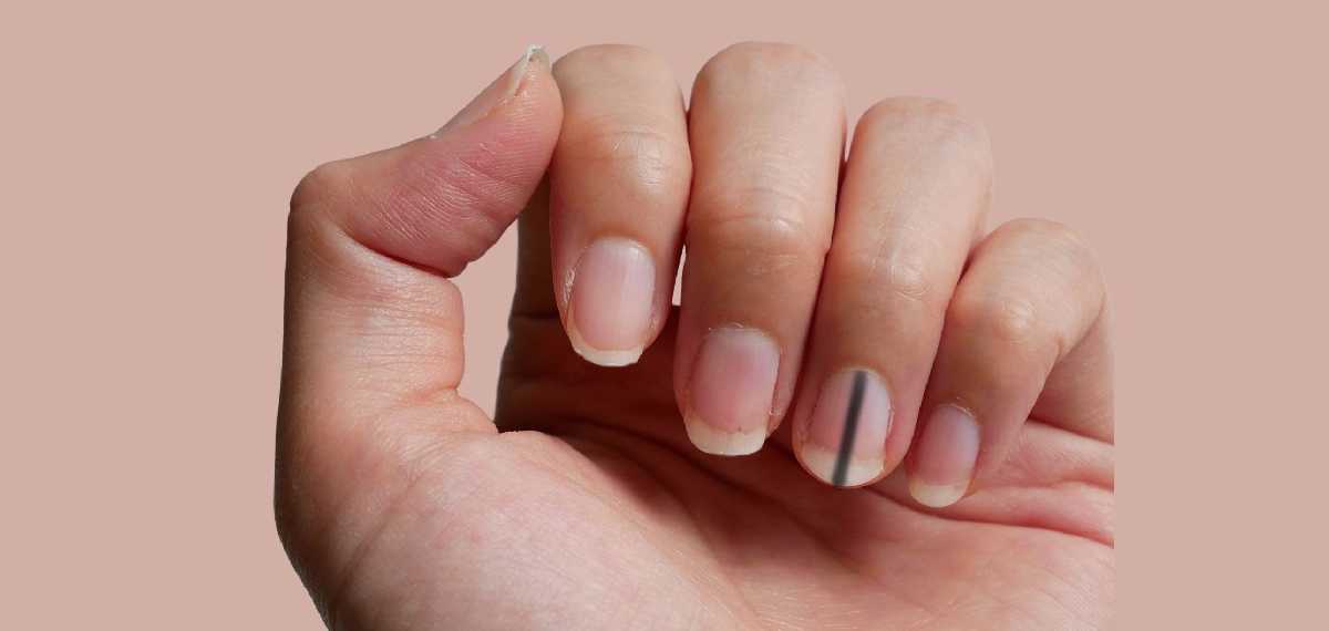black lines in nails