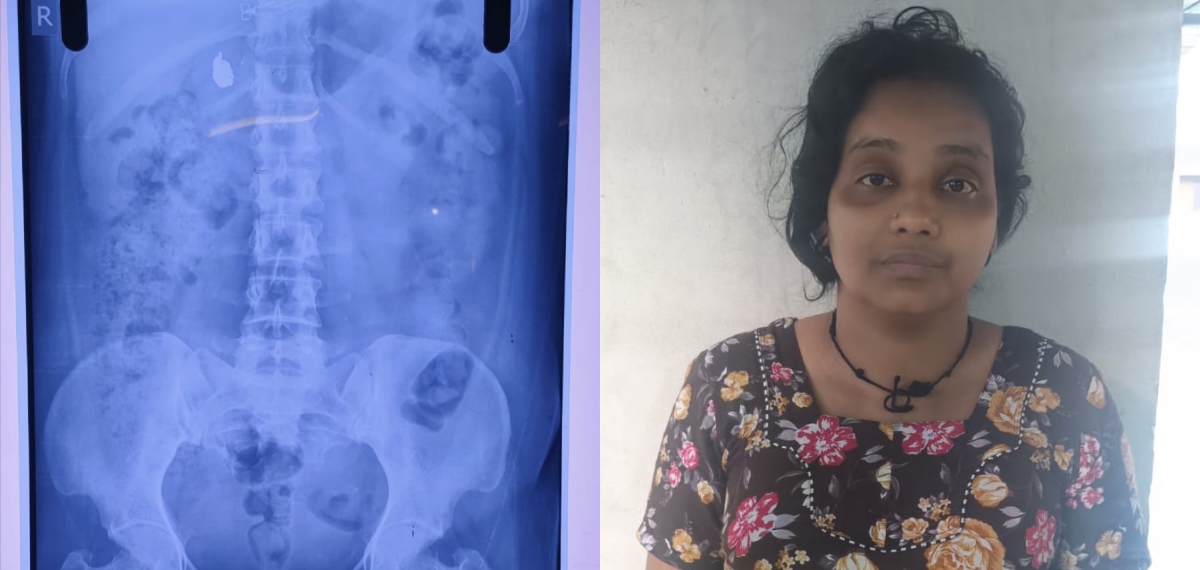 മോഷ്ടിച്ച മാല യുവതി വിഴുങ്ങി; വീണ്ടെടുക്കാൻ കാത്തിരുന്ന് പൊലീസ്; സംഭവം നിലമ്പൂരിൽ