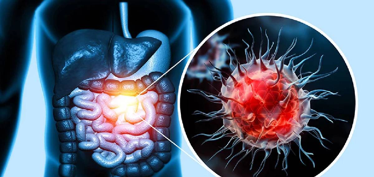 30-40 വയസിലെത്തിയവരിലെ വന്‍കുടല്‍ കാന്‍സറിന്റെ 4 ലക്ഷണങ്ങള്‍
