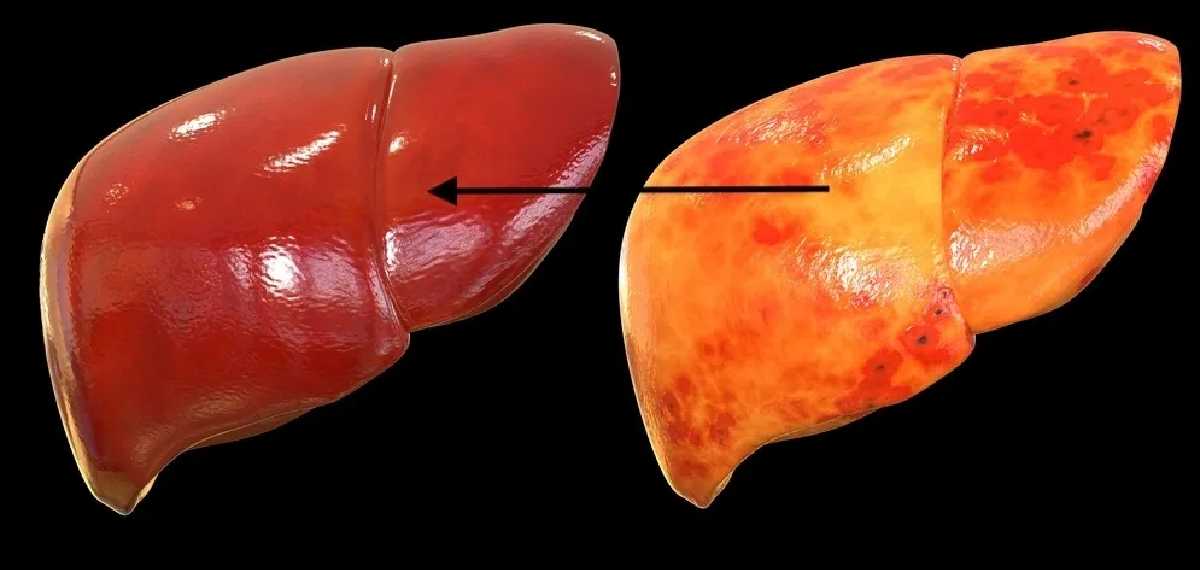 fatty liver