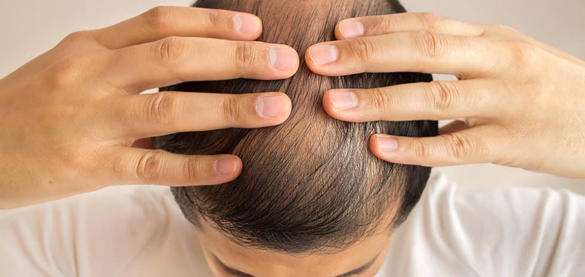 കഷണ്ടി വിഗ്ഗ് വെച്ച് മറച്ചു; ഭർത്താവിന് മുടിയില്ലെന്ന്  ഭാര്യ തിരിച്ചറിഞ്ഞത് വിവാഹ ശേഷം, പരാതി