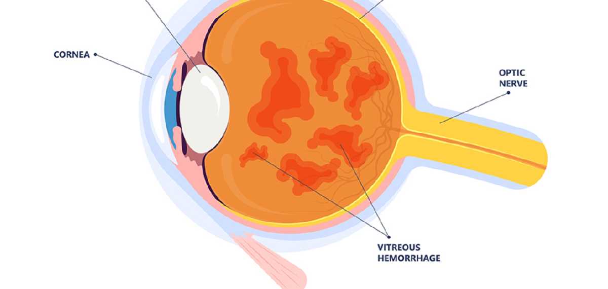 picture of viterous hemorrhage 