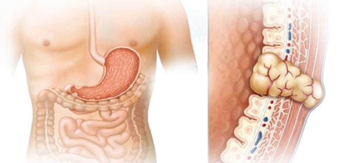 gastrointestinal stromal tumors, or GISTs